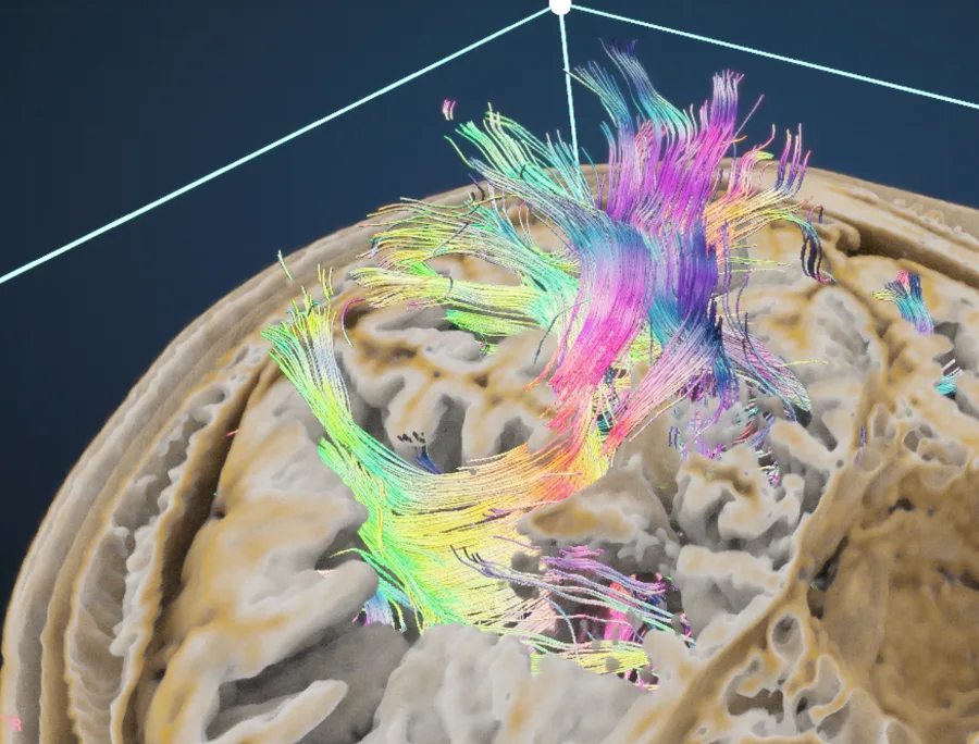 DTI tractography
