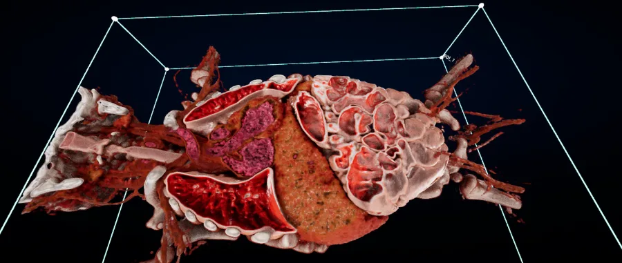 Thorax CT with clipping box